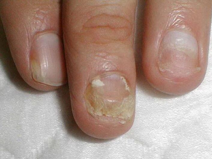 candidal treatment of nail fungus