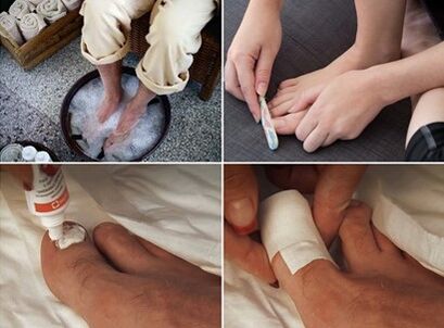 Steaming the feet and applying urea cream on the nails affected by the fungus