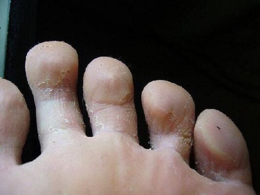 what does foot fungus look like