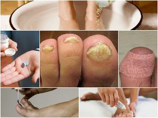 between the toes fungus treatment