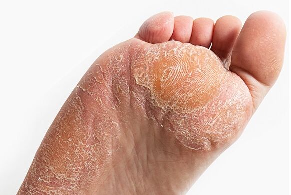peeling of the skin when infected with fungus