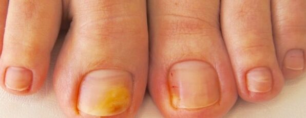 symptoms of fungus on the feet