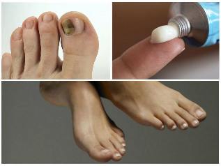toe nail fungus treatment