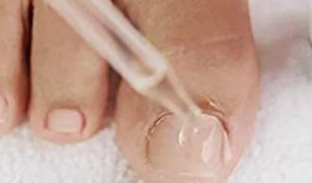 Drip nail fungus foot