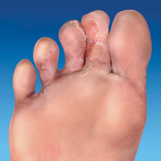 fungus, skin, feet