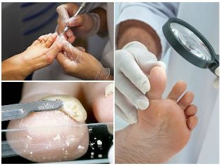 the fungus on the skin of the foot diagnosis