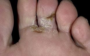 this type of foot fungus